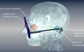 retina implant